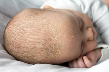 Mléčná krusta u novorozence a starších dětí. Pomůže šampon, speciální krém i olivový olej