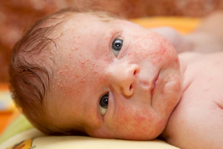 Co je to novorozenecké akné?