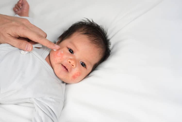 Novorozenecké vs kojenecké akné