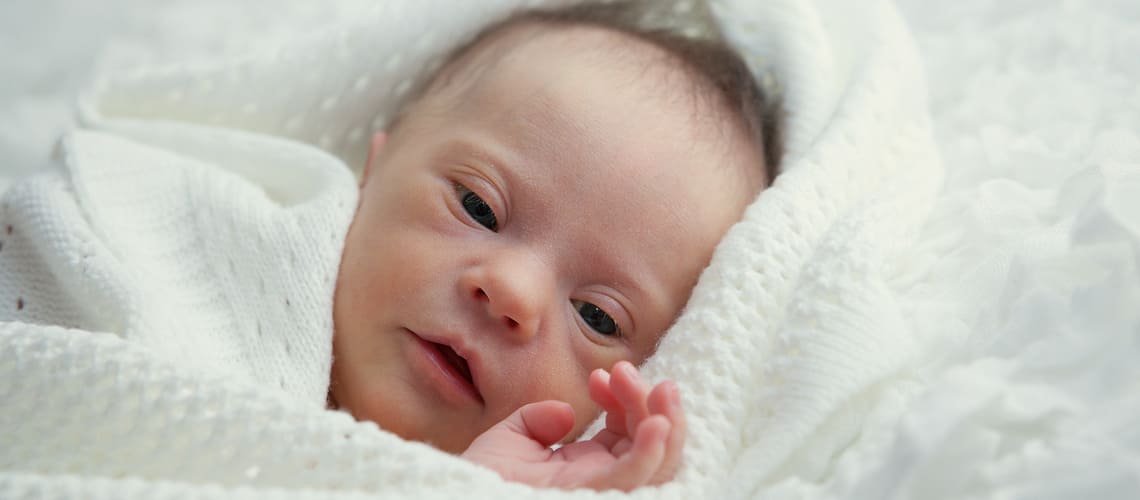Jaké jsou příznaky Downova syndromu u novorozence?
