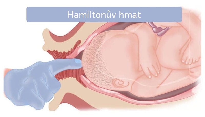 Hamiltonův hmat na vyvolání porodu