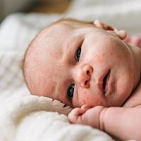 Novorozenecké akné na tváři