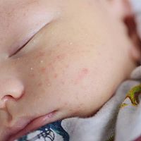 Novorozenecké akné příznaky