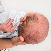 Novorozenecké akné ve vlasech