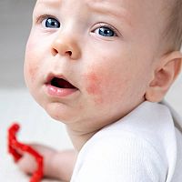 Novorozenecké akné léčba