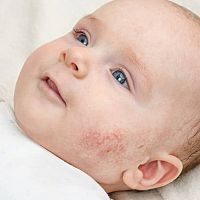 Novorozenecké akné na tvářích