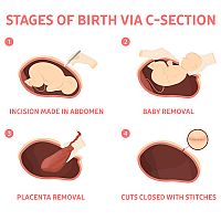 Fáze porodu císařským řezem