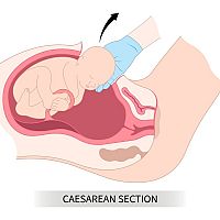 Císařský řez porod