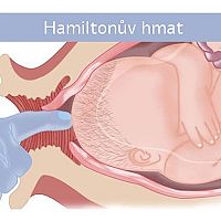 Hamiltonův hmat na vyvolání porodu